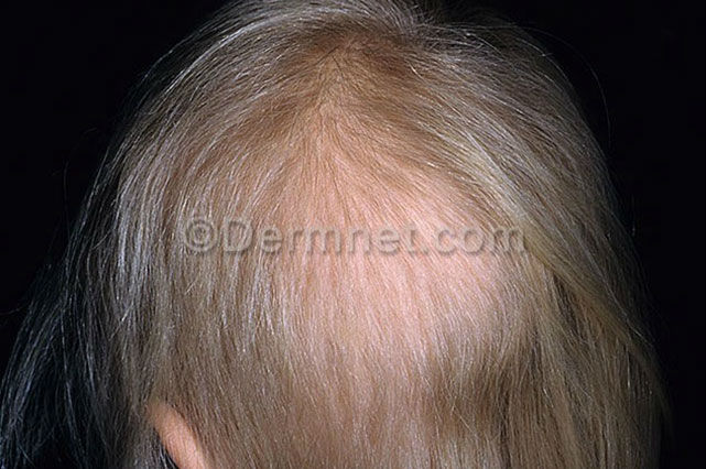 ALOPECIA AREATA