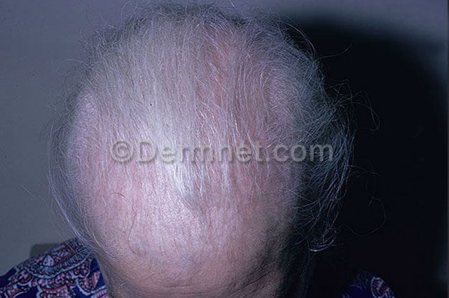 ALOPECIA AREATA
