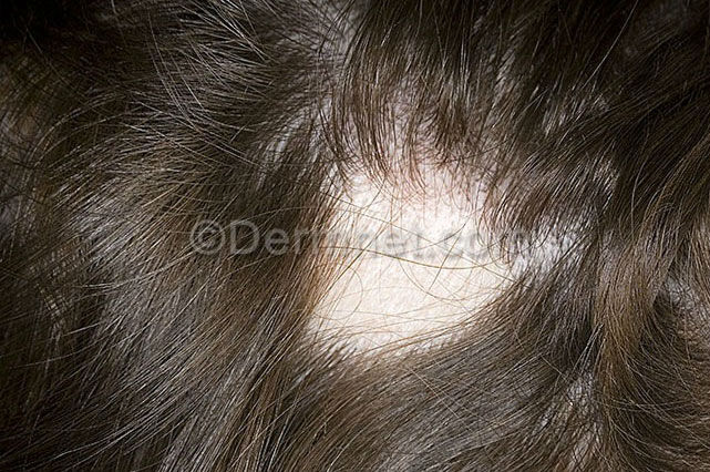 ALOPECIA AREATA