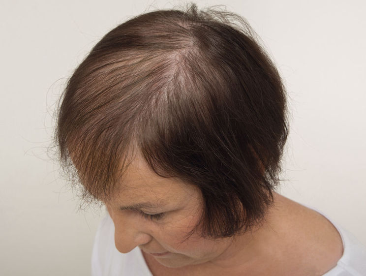 Hair loss - Before