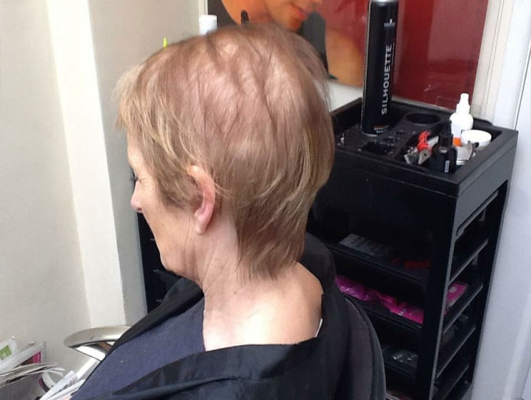 Hair loss - Before