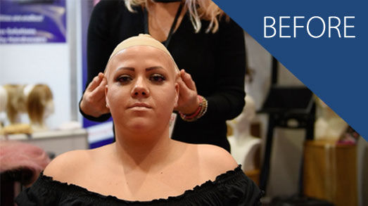 Hair Loss - Before