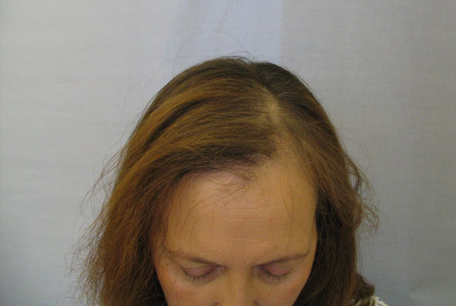 Radiotherapy And Hair Loss