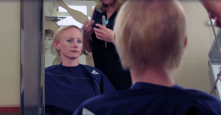 Hair loss - Before